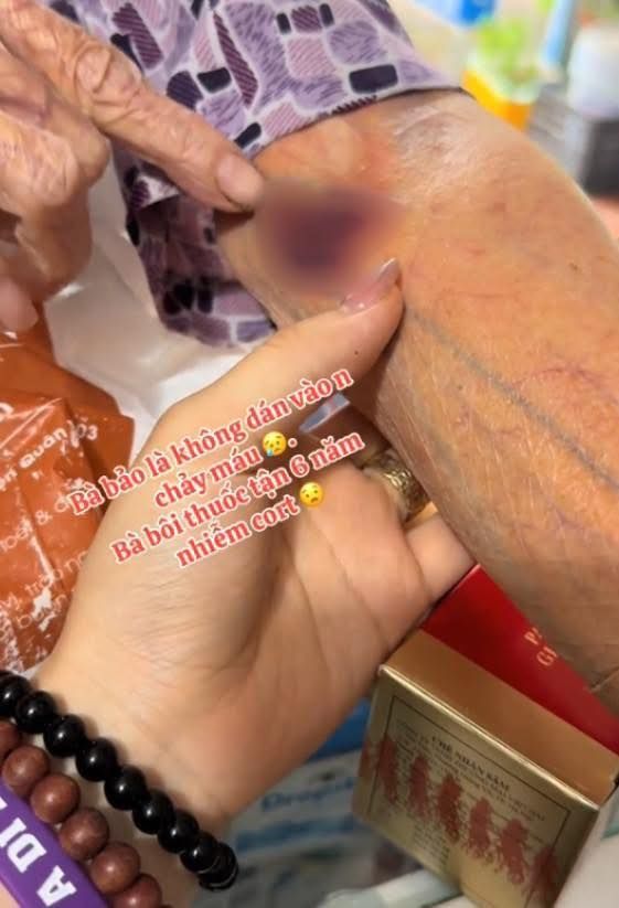 Choáng với cánh tay của cụ bà lạm dụng corticoid, da 