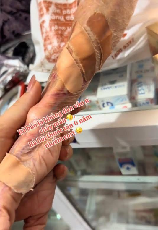 Choáng với cánh tay của cụ bà lạm dụng corticoid, da 
