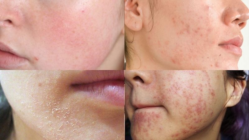 Choáng với cánh tay của cụ bà lạm dụng corticoid, da &quot;mỏng tang&quot;, chạm nhẹ cũng chảy máu: Corticoid có trong sản phẩm nào?- Ảnh 4.