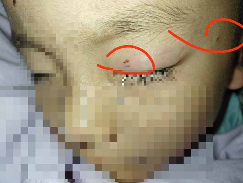 Cậu bé bị nhiễm trùng, mù một bên mắt vì hành động của giáo viên - Ảnh 1. img