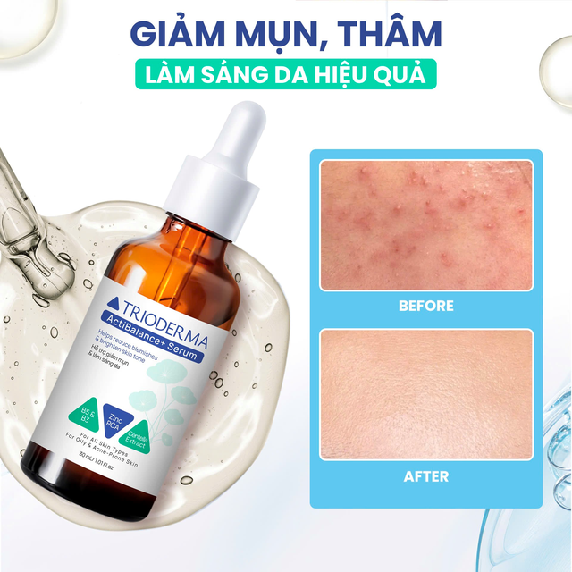 Review Trioderma ActiBalance+ Serum: Giải pháp kép cho da mụn và xỉn màu - Ảnh 1. Review Trioderma ActiBalance+ Serum: Giải pháp kép cho da mụn và xỉn màu - Ảnh 1.