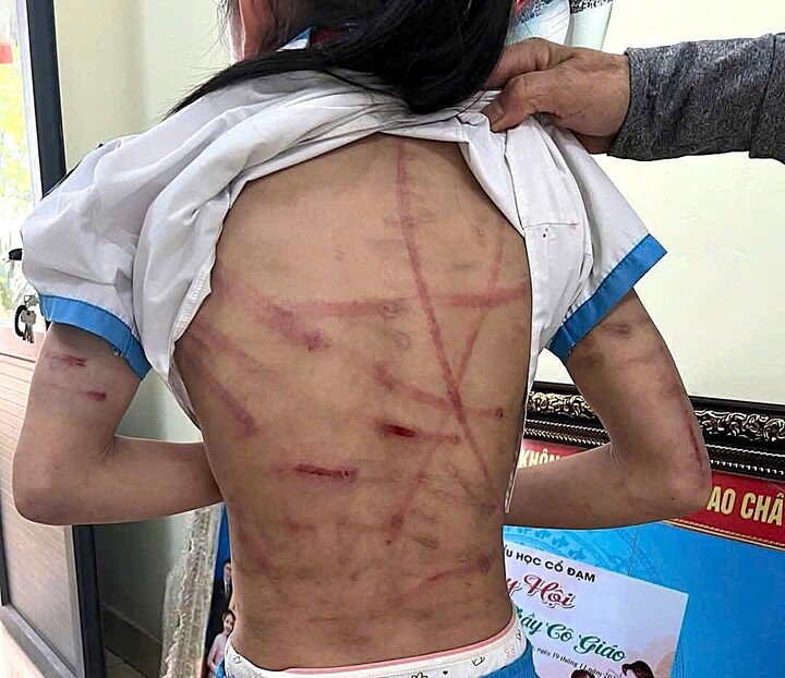 Bé gái lớp 5 ở Hà Tĩnh bị cha dượng bạo hành dã man: Đây không phải lần đầu - Ảnh 3.