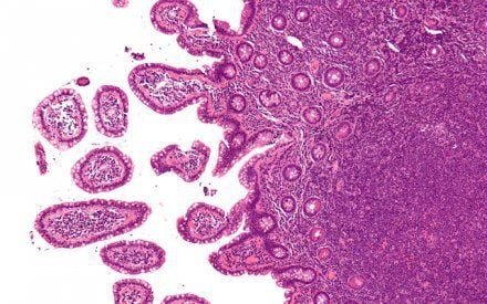 23 tuổi phát hiện mắc bệnh hiểm nghèo, cô gái trẻ không ngờ những dấu hiệu đã xuất hiện cả tháng trước đó- Ảnh 2. 23 tuổi phát hiện mắc bệnh hiểm nghèo, cô gái trẻ không ngờ những dấu hiệu đã xuất hiện cả tháng trước đó- Ảnh 2.