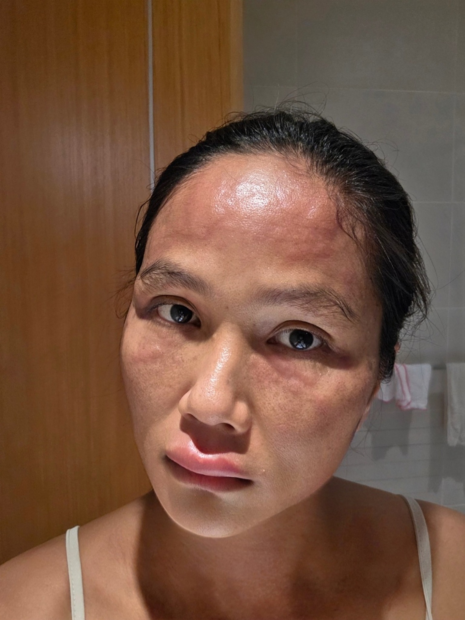 Hoa hậu H’Hen Niê khiến nhiều mẹ bỉm vừa xót xa vừa đồng cảm khi chia sẻ hình ảnh bị nổi mề đay sau sinh- Ảnh 2. Hoa hậu H’Hen Niê khiến nhiều mẹ bỉm vừa xót xa vừa đồng cảm khi chia sẻ hình ảnh bị nổi mề đay sau sinh- Ảnh 2.