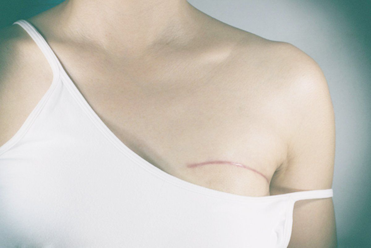 Tái tạo vú: Cuộc hồi sinh của người phụ nữ sau Tái tạo vú: Cuộc hồi sinh của người phụ nữ sau
