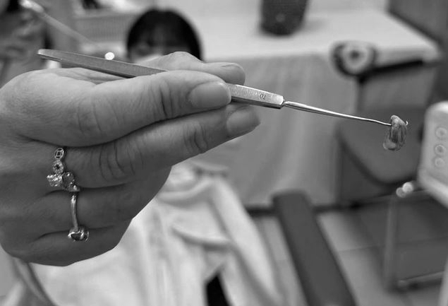 Bé 3 tuổi chảy nước mũi có mùi hôi khó chịu, bác sĩ gắp ra thứ &quot;đáng sợ&quot; bên trong- Ảnh 1.