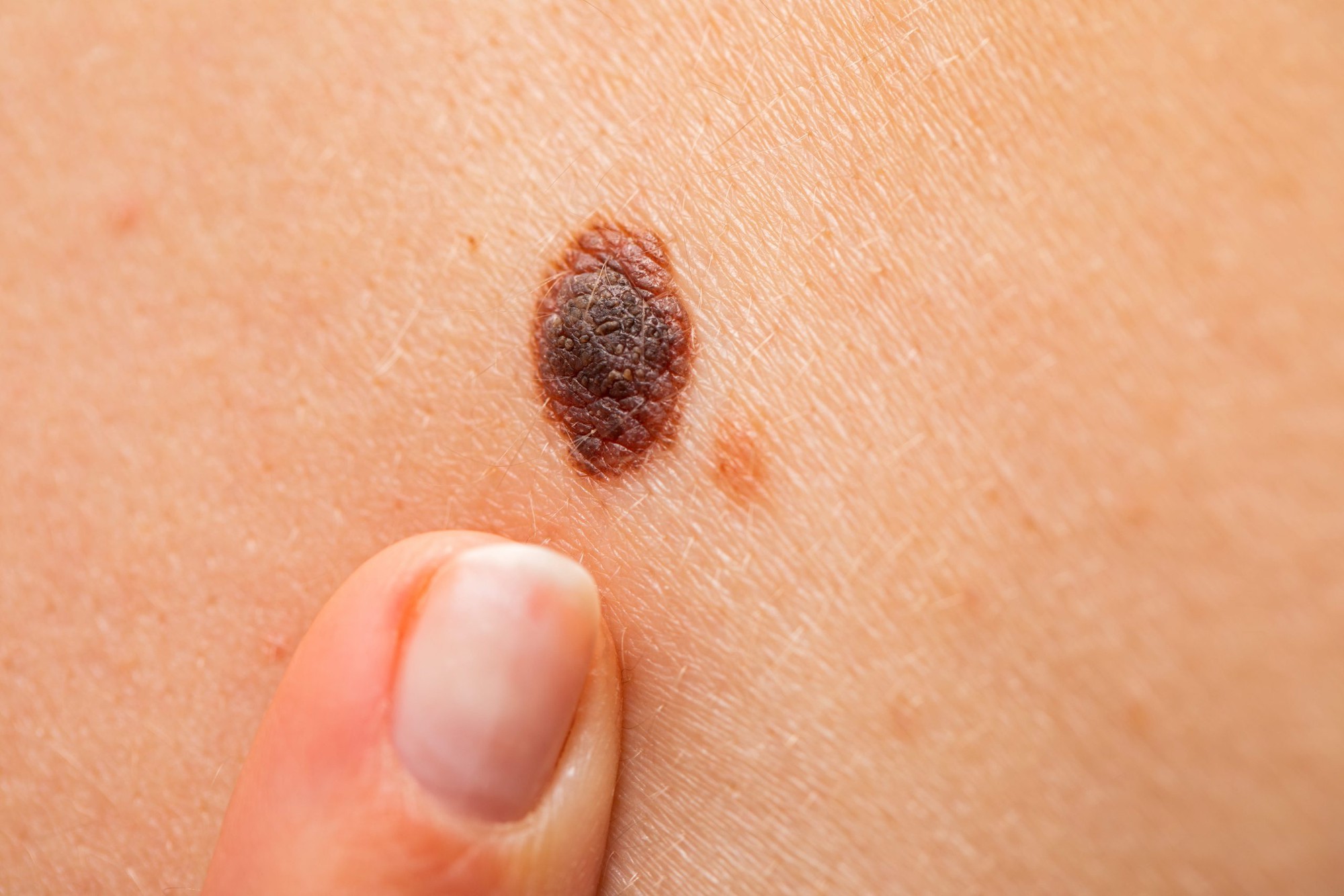 epi-blog-melanoma-scaled-1761265259694-17612652598571701960187.jpg