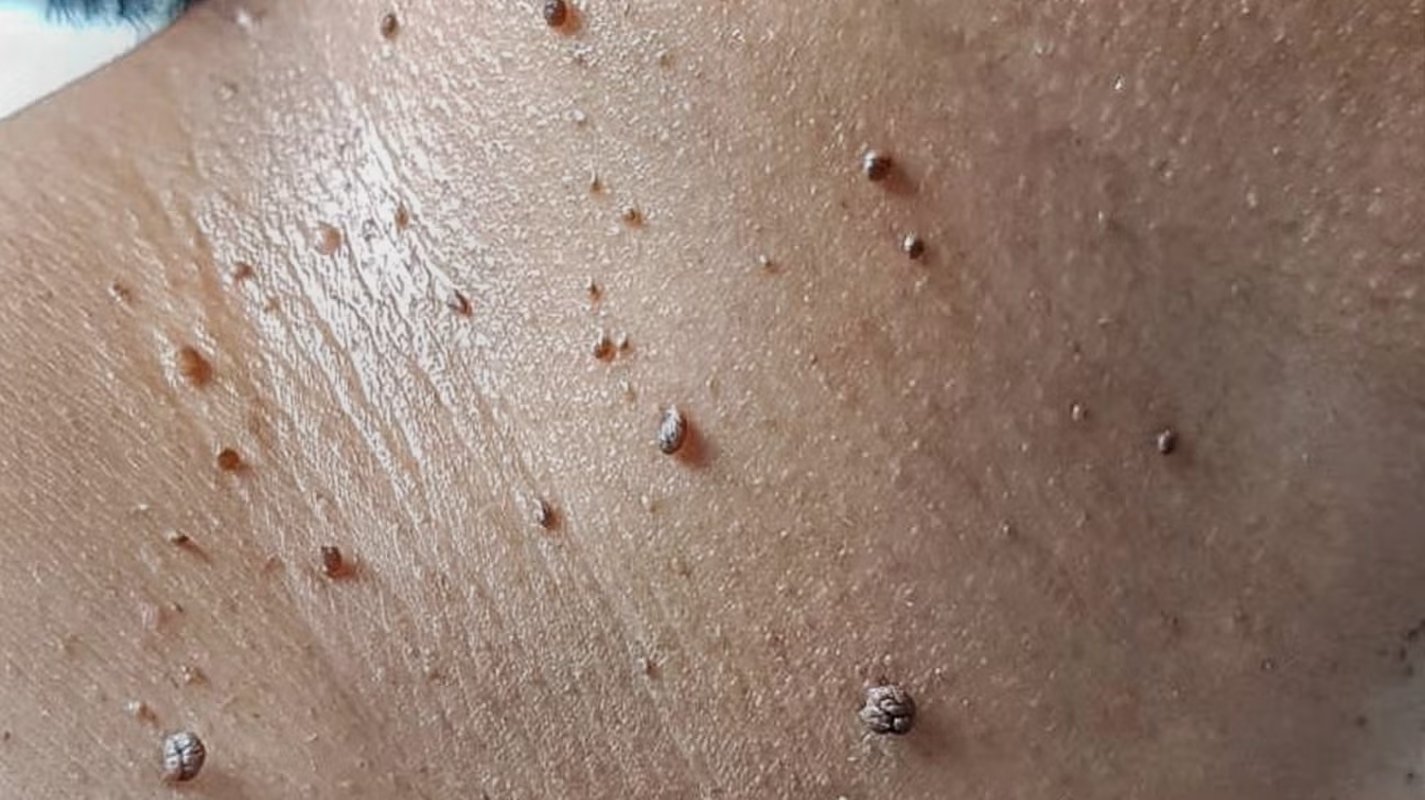 skin-tags-along-the-neck-1296x728-galleryslide2-1761265253432-17612652586146790830.jpg