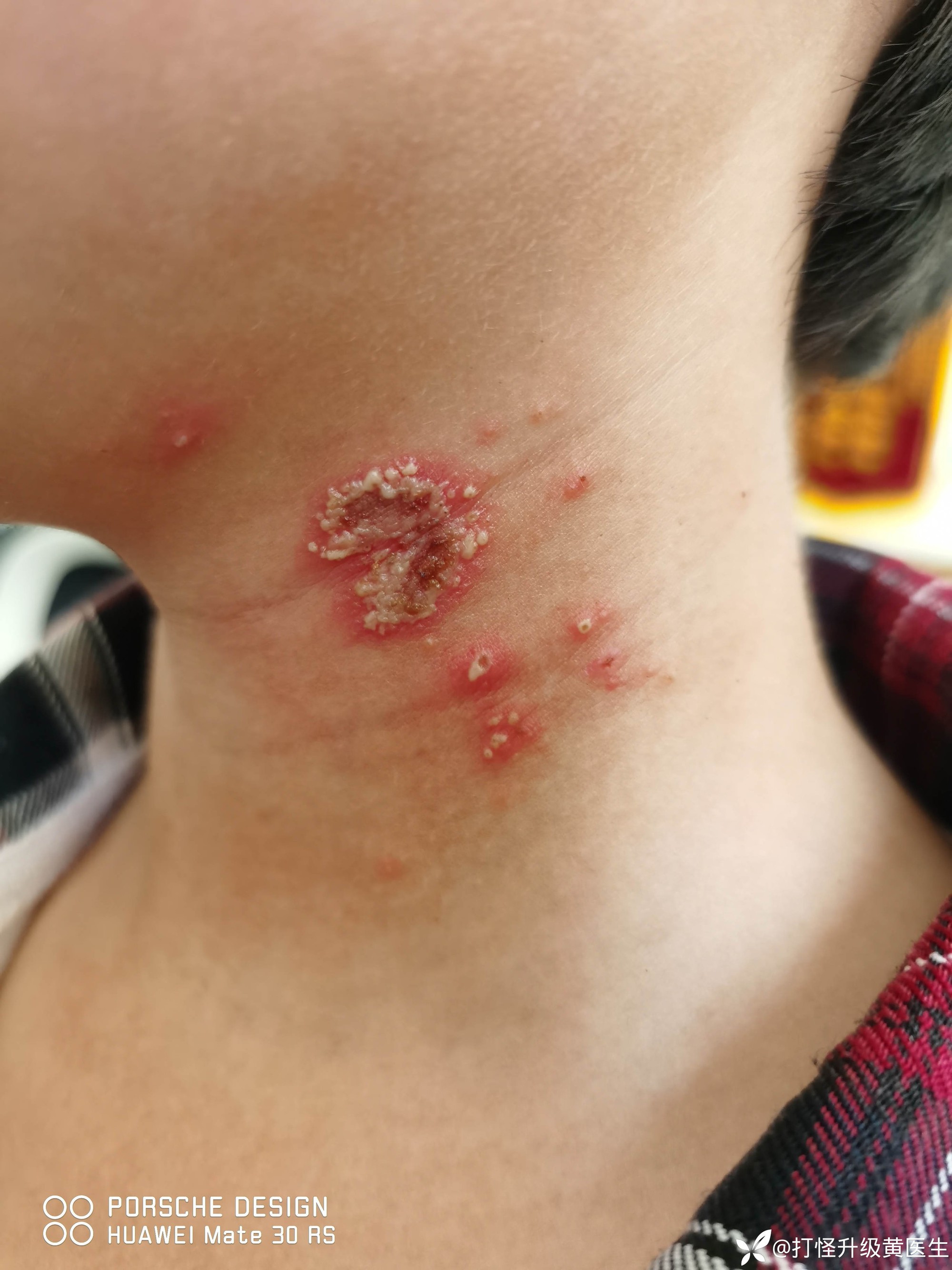 Bé trai 10 tuổi bỗng xuất hiện những nốt mẩn lạ trên da nhưng vẫn chưa tìm ra được nguyên nhân- Ảnh 2.