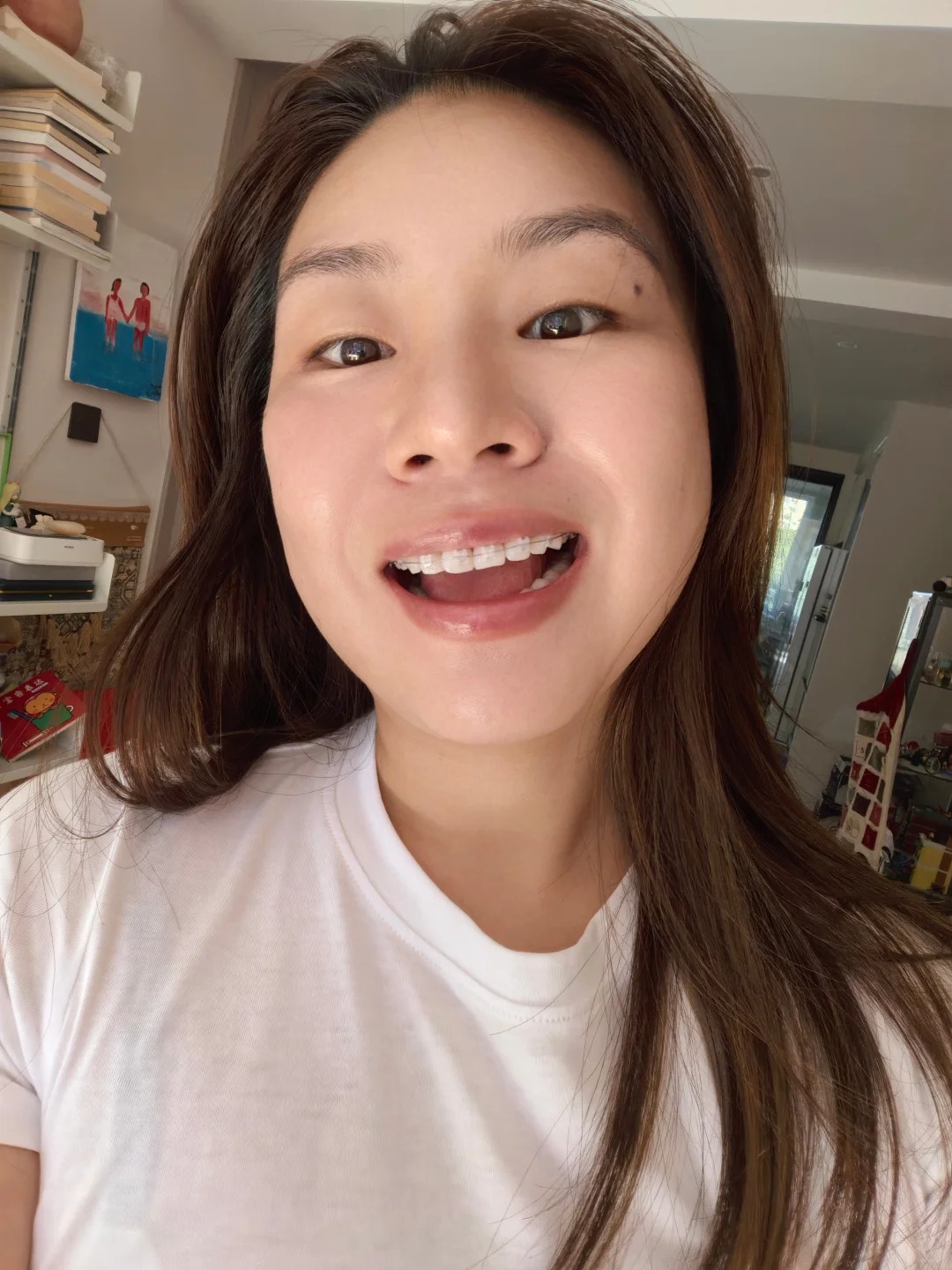 Niềng răng sứ và niềng trong suốt: Chọn gì để có nụ cười đẹp nhất? - Ảnh 2. Niềng răng sứ và niềng trong suốt: Chọn gì để có nụ cười đẹp nhất? - Ảnh 2.