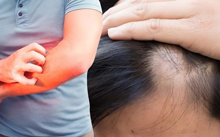 Người đàn ông 34 tuổi bị ngứa da đầu và qua đời sau 3 tháng: 4 cơn ngứa ngáy này xuất hiện thì có thể là bệnh nghiêm trọng hoặc ung thư