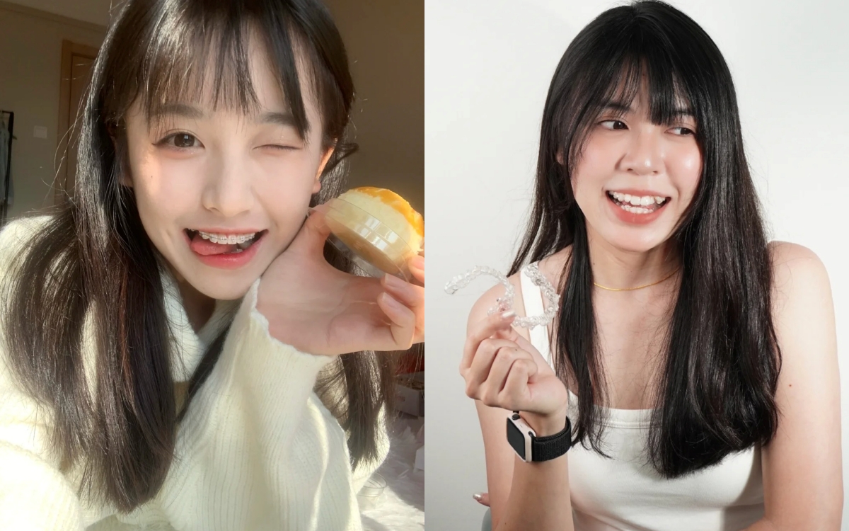 Niềng răng sứ và niềng trong suốt: Chọn gì để có nụ cười đẹp nhất? - Ảnh 1. Niềng răng sứ và niềng trong suốt: Chọn gì để có nụ cười đẹp nhất? - Ảnh 1.