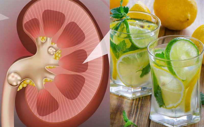Người đàn ông bị sỏi thận đã uống nước chanh mỗi ngày, anh được bác sĩ &quot;tặng&quot; ngay 5 từ trong lần tái khám