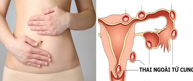 Nữ ca sĩ bị vỡ ống dẫn trứng do mang thai ngoài tử cung: "Vẫn uống thuốc giảm đau và bước ra sân khấu mà không biết nguy hiểm đang chờ"- Ảnh 3. Nữ ca sĩ bị vỡ ống dẫn trứng do mang thai ngoài tử cung: "Vẫn uống thuốc giảm đau và bước ra sân khấu mà không biết nguy hiểm đang chờ"- Ảnh 3.