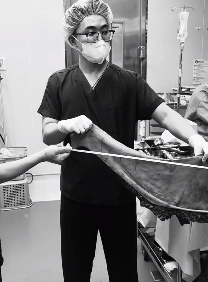 Cận cảnh bộ da thừa dài 171cm, nặng 6kg được cắt bỏ thành công của chàng thanh niên từng nặng 264kg- Ảnh 3. Cận cảnh bộ da thừa dài 171cm, nặng 6kg được cắt bỏ thành công của chàng thanh niên từng nặng 264kg- Ảnh 3.
