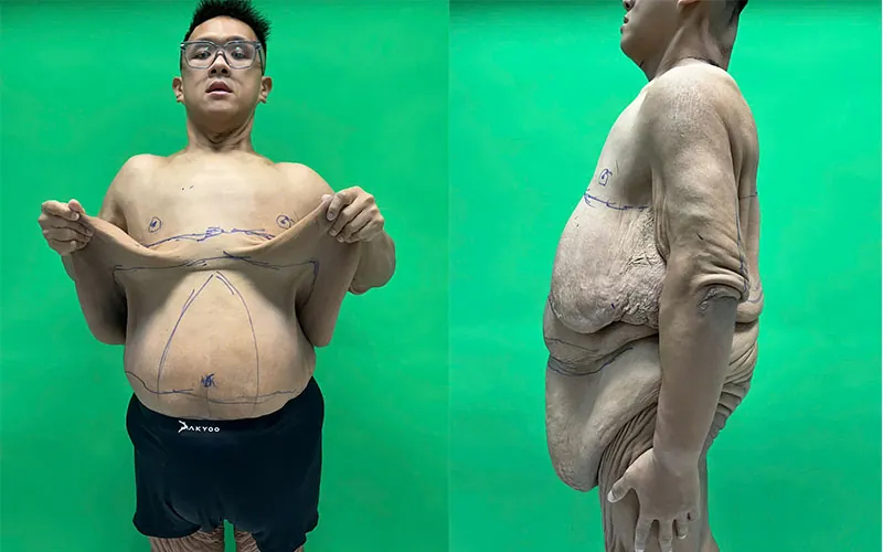 Cận cảnh bộ da thừa dài 171cm, nặng 6kg được cắt bỏ thành công của chàng thanh niên từng nặng 264kg- Ảnh 6. Cận cảnh bộ da thừa dài 171cm, nặng 6kg được cắt bỏ thành công của chàng thanh niên từng nặng 264kg- Ảnh 6.