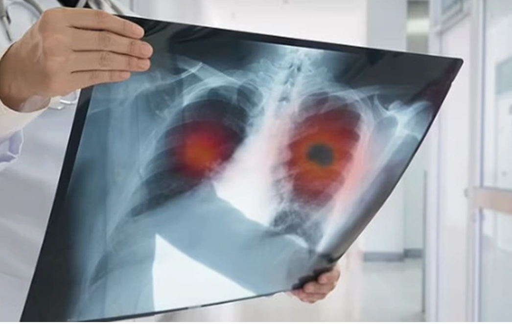 32 tuổi sống lành mạnh, sức khỏe tốt: Có 1 triệu chứng kéo dài 2 tuần, đi khám bỗng nhận kết quả K phổi - Ảnh 1.