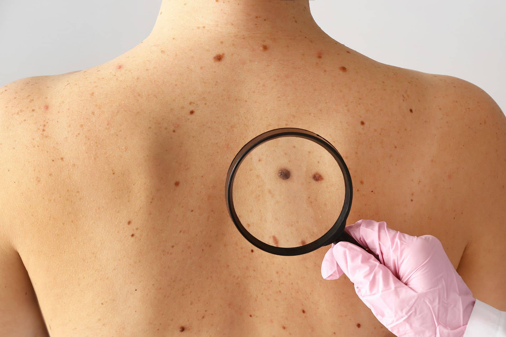 early-detection-spot-skin-cancer-17631766281111224039957-1763202146120-1763202146370900097329.jpg