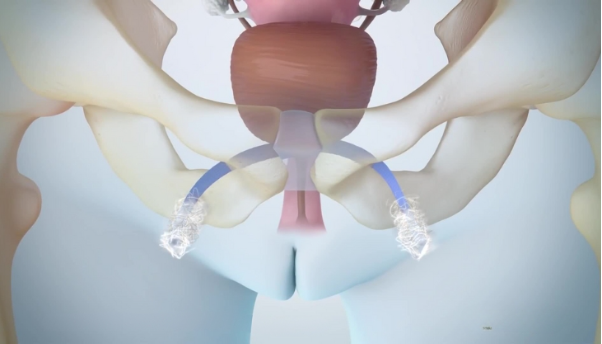 Người phụ nữ Ukraine vượt ngàn Km điều trị són tiểu tại BVĐK Hồng Ngọc - Ảnh 4. Người phụ nữ Ukraine vượt ngàn Km điều trị són tiểu tại BVĐK Hồng Ngọc - Ảnh 4.