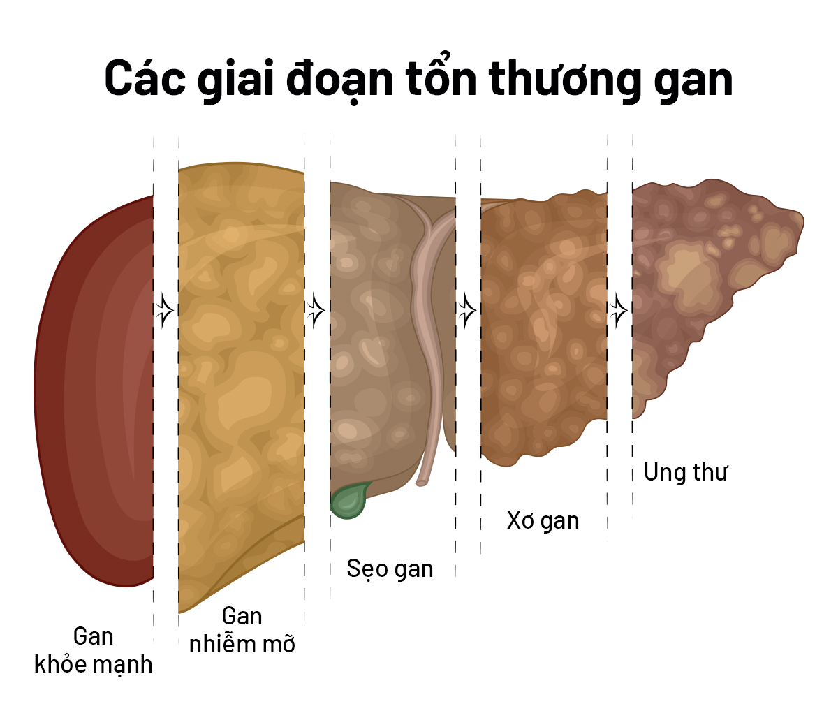 cac-kien-thuc-ban-nen-biet-ve-gan-nhiem-mo-1-1762064226984-17620642271741452286103.jpg