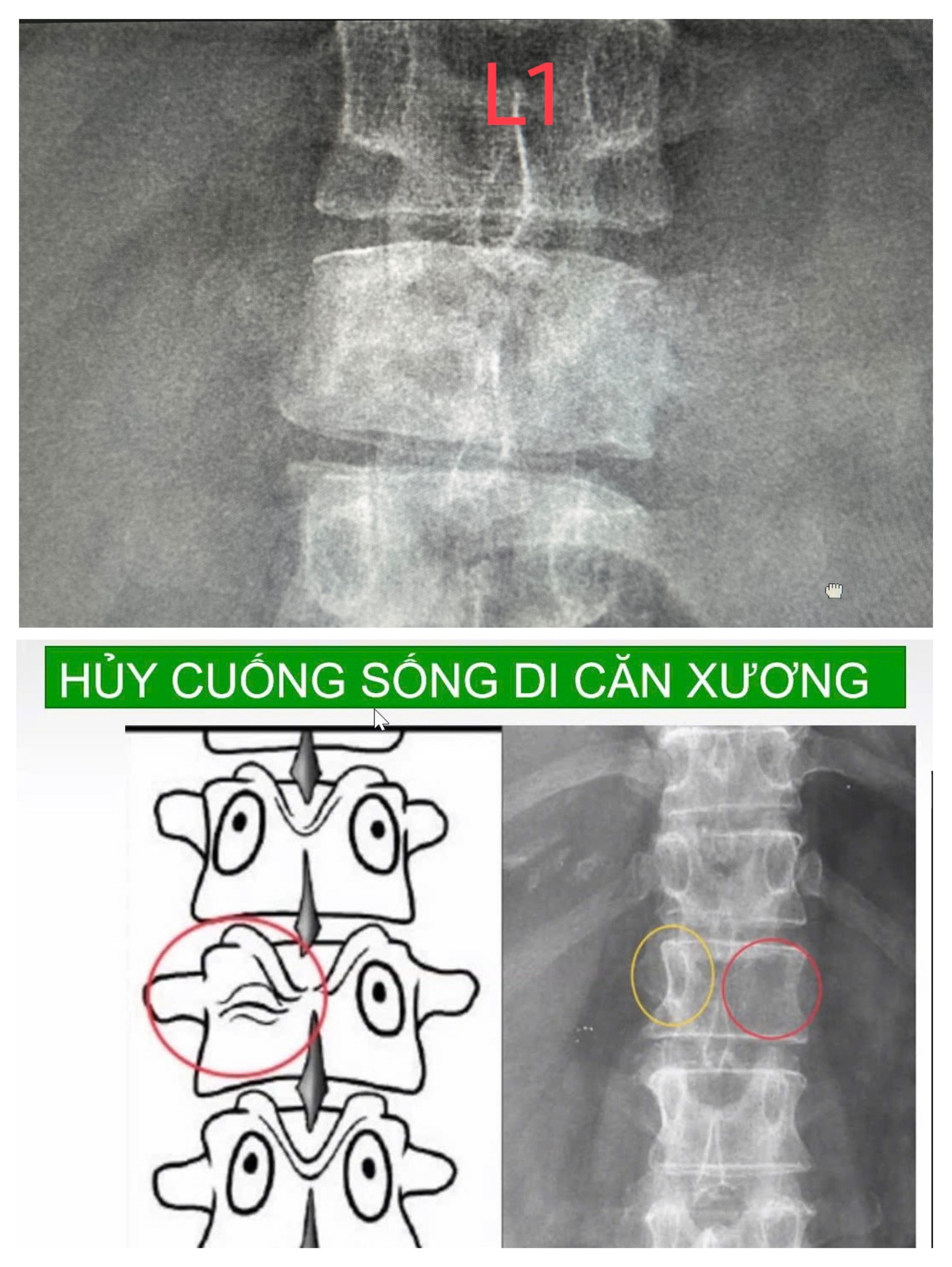 Đau lưng kéo dài cứ tự uống thuốc giảm đau, chàng trai 26 tuổi ở Hà Nội đi khám phát hiện ung thư xương di căn- Ảnh 1.