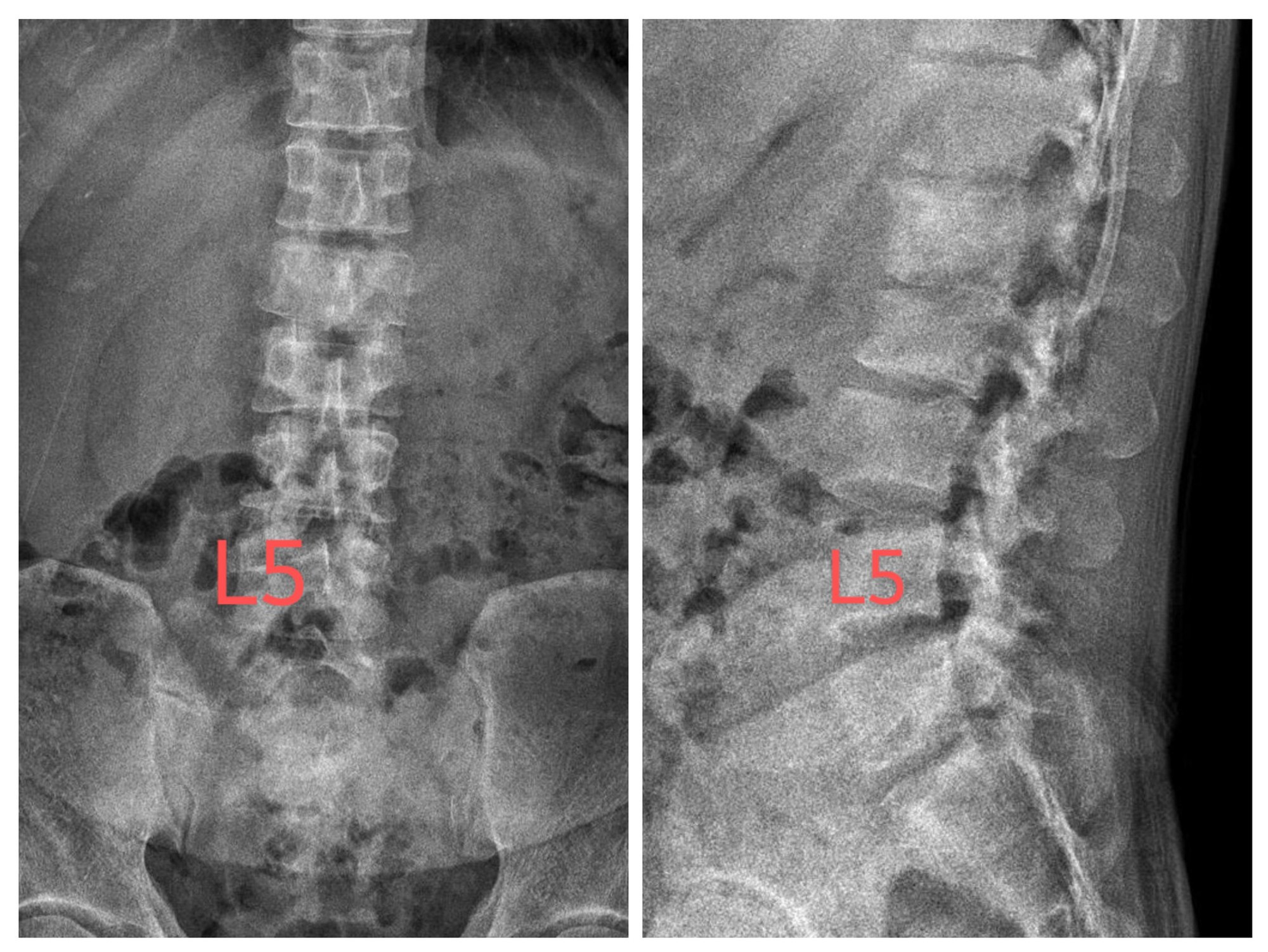 Đau lưng kéo dài cứ tự uống thuốc giảm đau, chàng trai 26 tuổi ở Hà Nội đi khám phát hiện ung thư xương di căn- Ảnh 2.