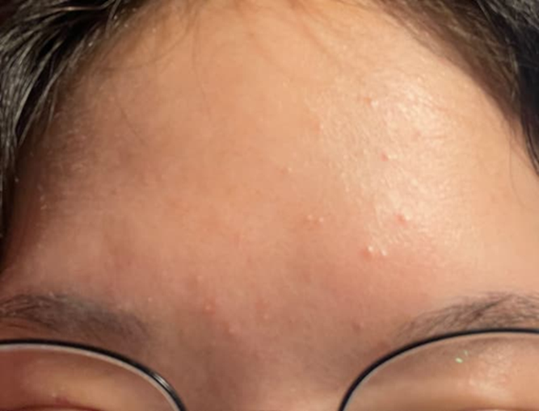 Con gái mọc mụn trứng cá, mẹ xin nghỉ phép đưa con đi cấp cứu- Ảnh 1. Con gái mọc mụn trứng cá, mẹ xin nghỉ phép đưa con đi cấp cứu- Ảnh 1.