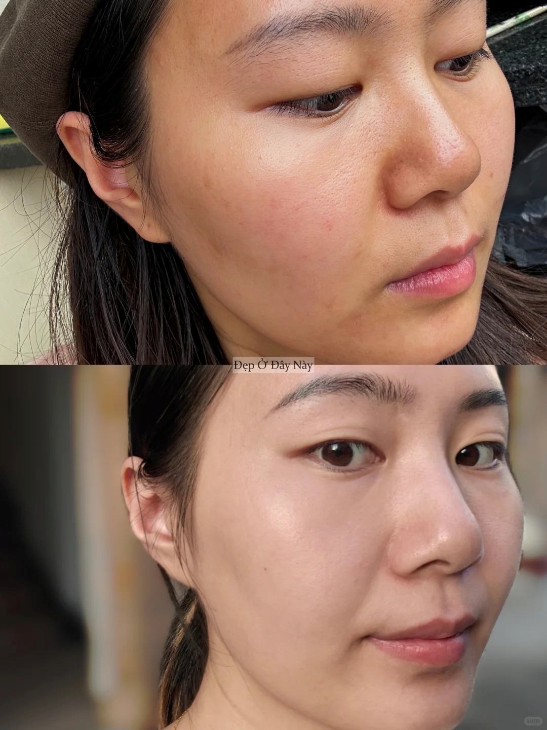 Bác sĩ da liễu không bán sản phẩm - chỉ đưa chu trình, và da tôi đẹp lên thật! - Ảnh 3.