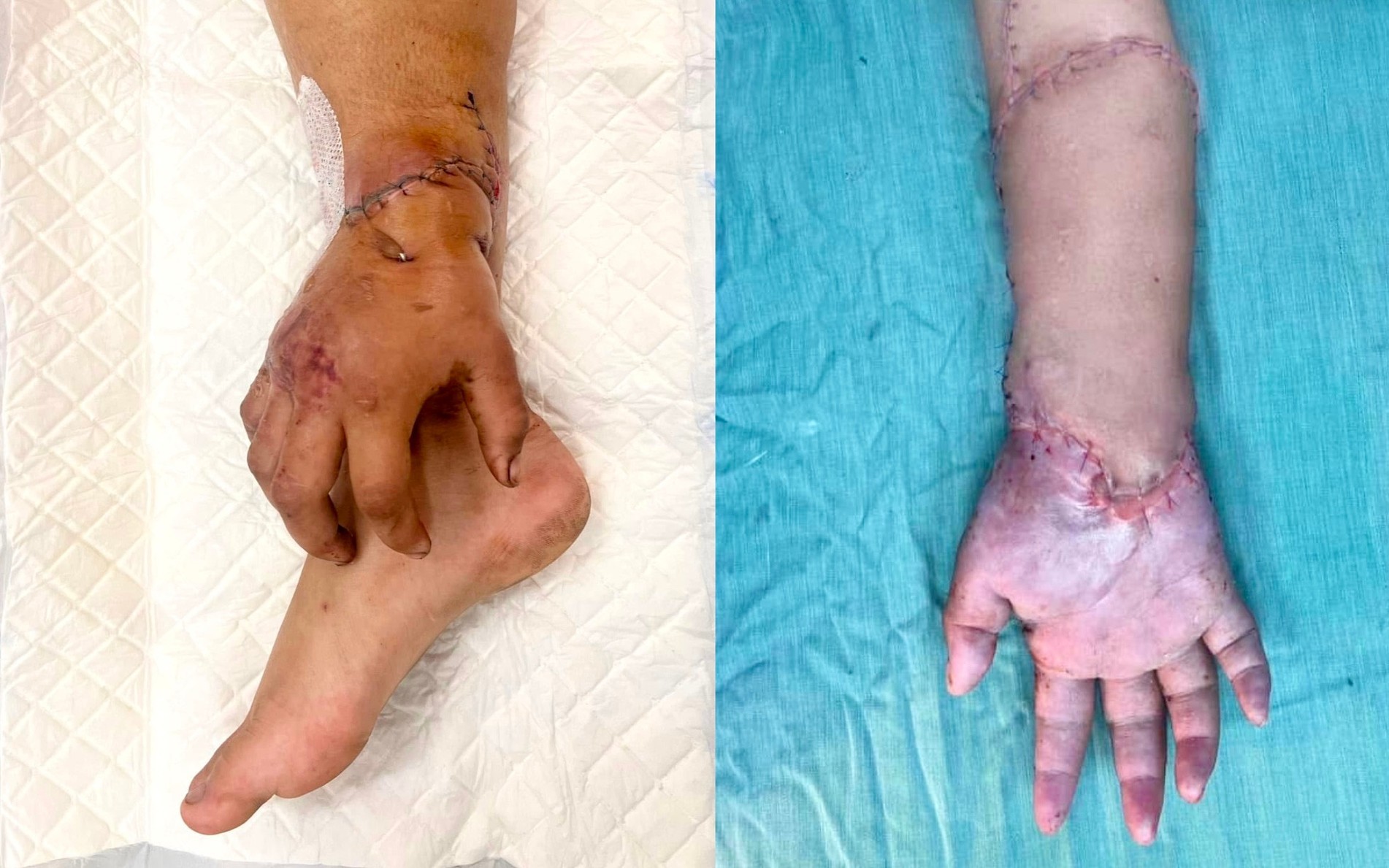 Mẹ bầu song thai từng được 'nuôi tạm' bàn tay ở cẳng chân sinh con an toàn - Ảnh 2.