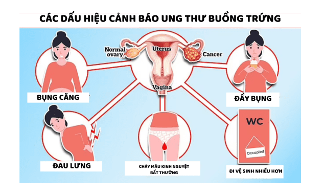 Cuộc chiến sống còn của người phụ nữ 50 tuổi sau khi phẫu thuật loại bỏ 7 cơ quan vì ung thư buồng trứng giai đoạn 4- Ảnh 2.