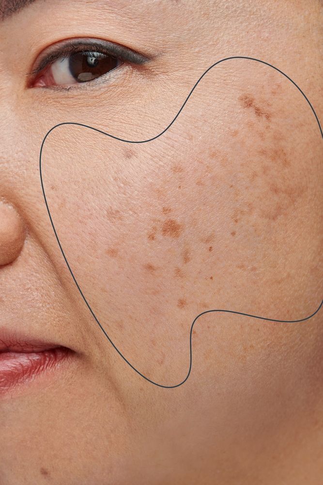 Trị nám tuổi 40 không hề khó nếu bạn bổ sung 2 dưỡng chất này mỗi ngày, phụ nữ trung niên càng nên áp dụng - Ảnh 2. Trị nám tuổi 40 không hề khó nếu bạn bổ sung 2 dưỡng chất này mỗi ngày, phụ nữ trung niên càng nên áp dụng - Ảnh 2.