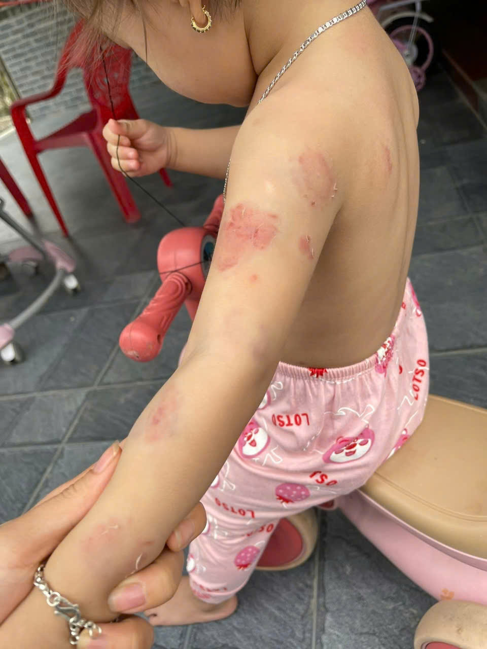 Bé gái 2 tuổi bị thương nặng khiến phụ huynh bức xúc tại Hà Tĩnh - Ảnh 1. Bé gái 2 tuổi bị thương nặng khiến phụ huynh bức xúc tại Hà Tĩnh - Ảnh 1.