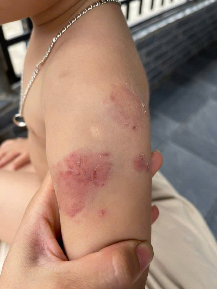 Bé gái 2 tuổi bị thương nặng khiến phụ huynh bức xúc tại Hà Tĩnh - Ảnh 2. Bé gái 2 tuổi bị thương nặng khiến phụ huynh bức xúc tại Hà Tĩnh - Ảnh 2.