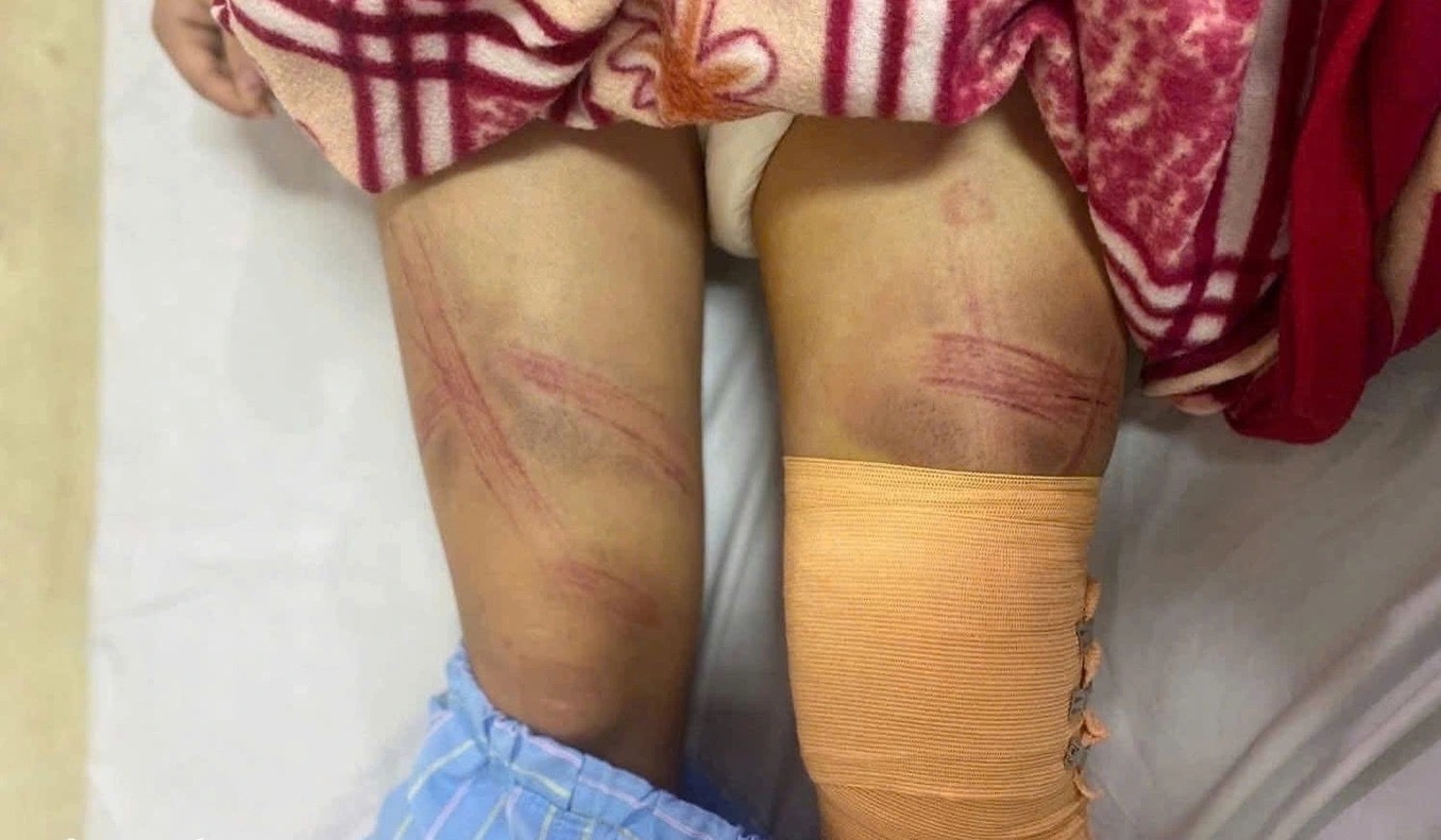 Vụ b&eacute; g&aacute;i lớp 7 bị bố đ&aacute;nh nhập viện: Nguồn cơn từ con lợn đất? - Ảnh 1.