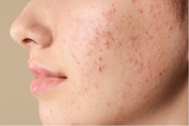 Trị th&acirc;m mụn thế n&agrave;o cho hiệu quả v&agrave; an to&agrave;n? G&oacute;c nh&igrave;n từ chuy&ecirc;n gia thẩm mỹ - Ảnh 1.