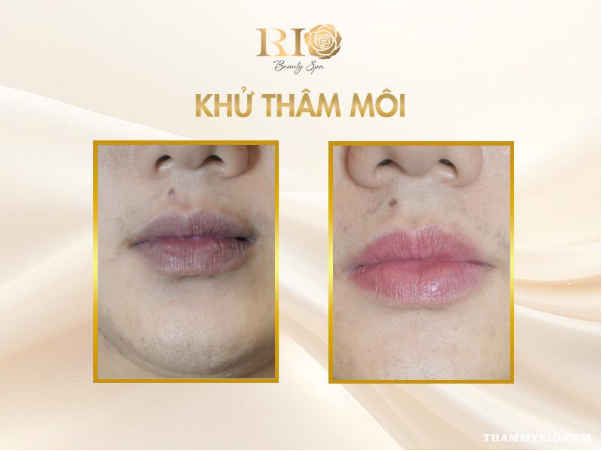 Hết th&acirc;m m&ocirc;i nhanh nhờ c&ocirc;ng nghệ khử th&acirc;m m&ocirc;i mới - Ảnh 1.