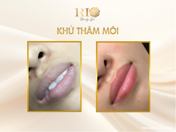 Hết th&acirc;m m&ocirc;i nhanh nhờ c&ocirc;ng nghệ khử th&acirc;m m&ocirc;i mới - Ảnh 2.