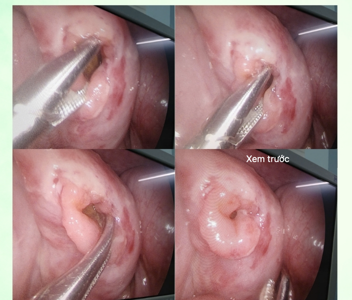 Tai nạn xe đạp điện, b&eacute; trai 6 tuổi nguy kịch v&igrave; vỡ ruột - Ảnh 1.