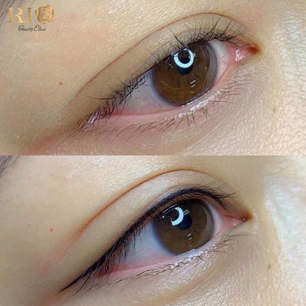 Phun mí Glamor tạo điểm nhấn cho đôi mắt tại Thẩm Mỹ Rio - Ảnh 1. Phun mí Glamor tạo điểm nhấn cho đôi mắt tại Thẩm Mỹ Rio - Ảnh 1.