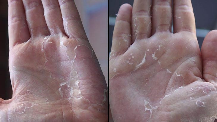 Khổ cả m&ugrave;a đ&ocirc;ng v&igrave; da tay da ch&acirc;n bong tr&oacute;c: Th&oacute;i quen nhiều người vẫn l&agrave;m m&agrave; kh&ocirc;ng nhận ra đang tự l&agrave;m đau m&igrave;nh- Ảnh 3.