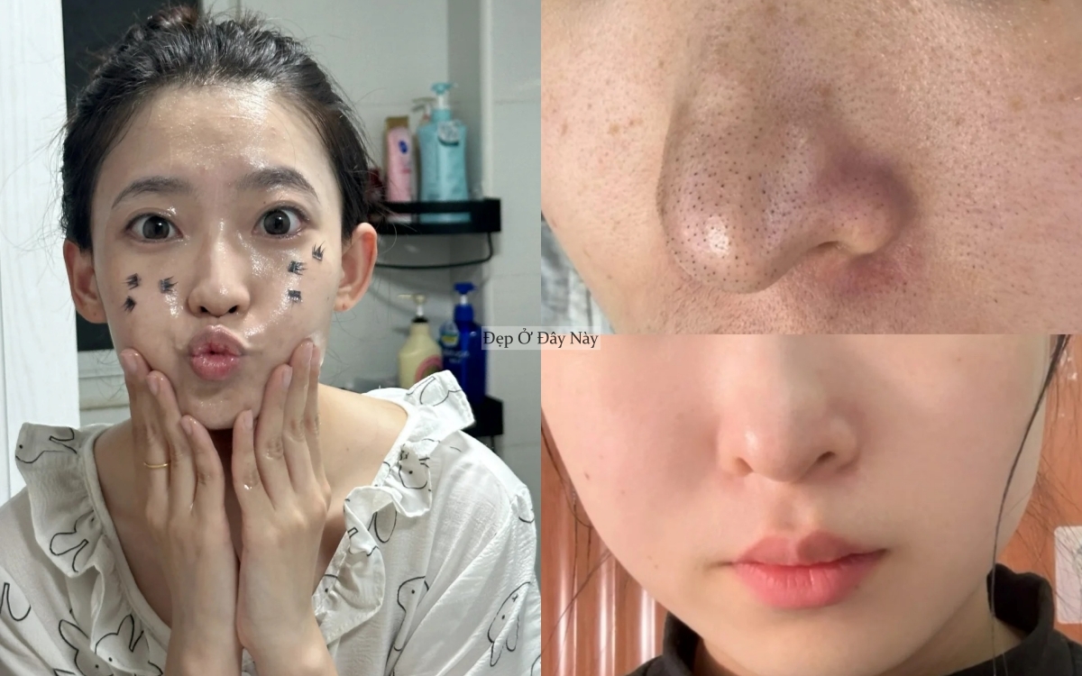 Kh&ocirc;ng cần da spa, c&oacute; 5 c&aacute;ch l&agrave;m sạch s&acirc;u lỗ ch&acirc;n l&ocirc;ng tại nh&agrave; để da l&aacute;ng mịn từ b&ecirc;n trong - Ảnh 1.