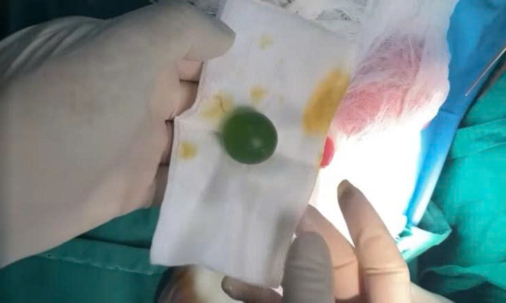 Bé13 tháng tuổi ăn gì nôn đấy, bác sĩ gắp ra thứ 