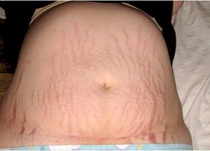 Vẫn biết phần lớn là do cơ địa, thế nhưng làm sao để vết sẹo mổ đẻ Vẫn biết phần lớn là do cơ địa, thế nhưng làm sao để vết sẹo mổ đẻ