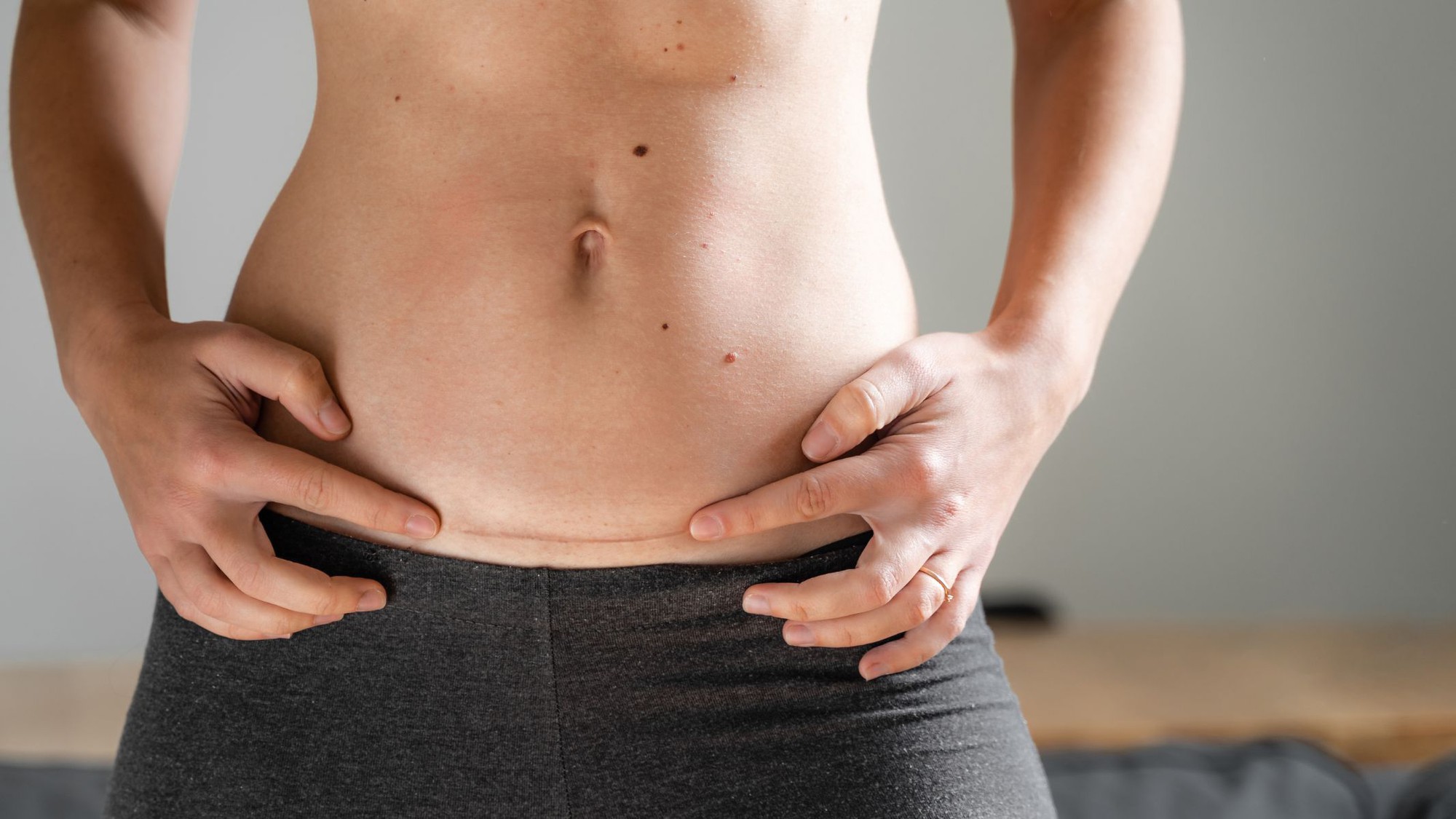 Vẫn biết phần lớn là do cơ địa, thế nhưng làm sao để vết sẹo mổ đẻ Vẫn biết phần lớn là do cơ địa, thế nhưng làm sao để vết sẹo mổ đẻ