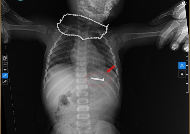 Đinh vít sắt dài 5cm trong dạ dày bé trai 15 tháng tuổi - Ảnh 1.