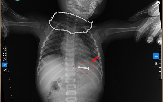 Đinh vít sắt dài 5cm trong dạ dày bé trai 15 tháng tuổi