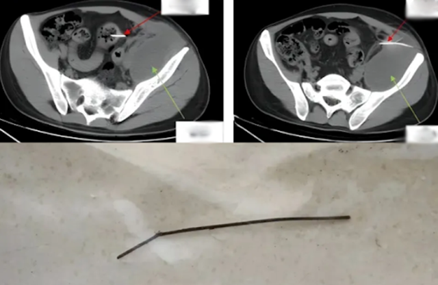 Chàng trai 28 tuổi đau bụng 3 tháng không đi lại được, đi khám bác sĩ &quot;lôi ra&quot; thứ dài 13cm từ trong bụng - Ảnh 1.