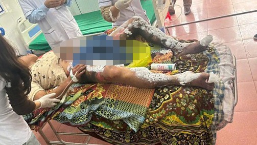 Điện thoại để trong túi quần phát nổ, nam thanh niên bỏng nặng vùng kín - Ảnh 1.