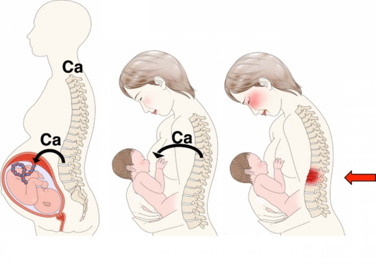 Loãng xương sau sinh - Nguy cơ thầm lặng thường bị bỏ qua - Ảnh 1.