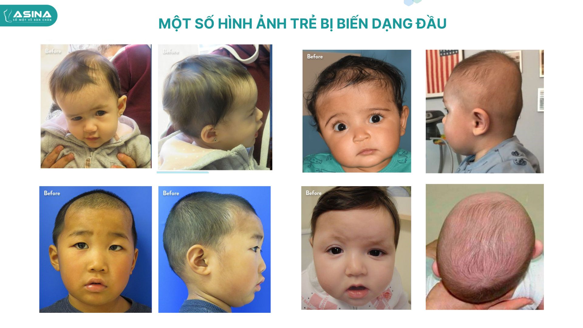 Hội chứng đầu méo, đầu bẹt ở trẻ và “trào lưu” sử dụng mũ chỉnh hình để can thiệp - Ảnh 2.